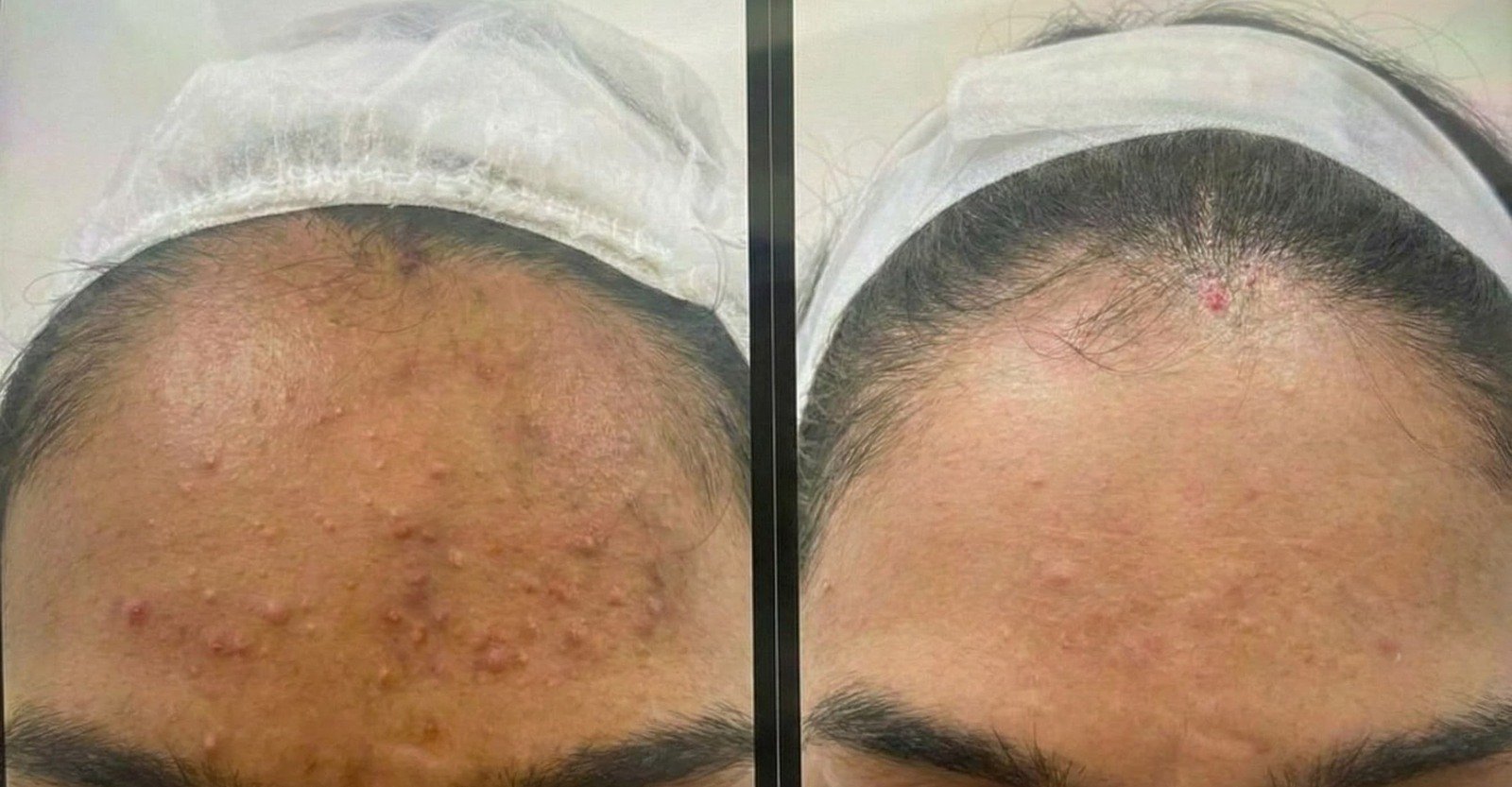 Before and after treatment: Acne & post-acne marks