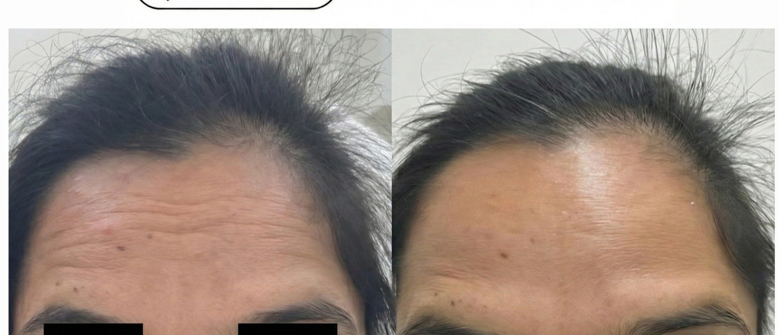 Before and after treatment: Forehead lines