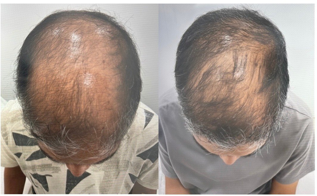 Before and after treatment: Hair restoration